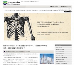 漏斗胸サイト